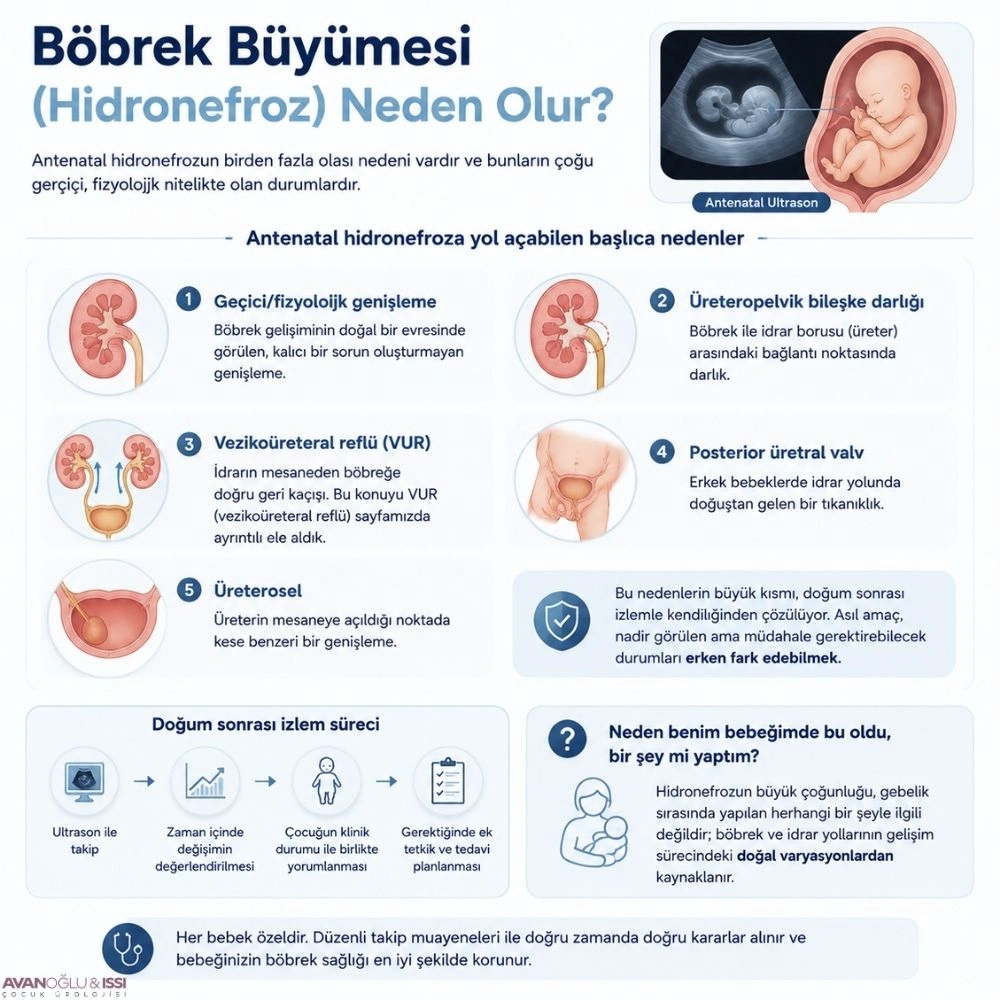 Antenatal hidronefroz nedir 