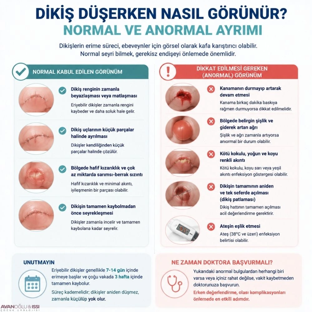 Sünnet Dikişleri Kaç Günde Düşer