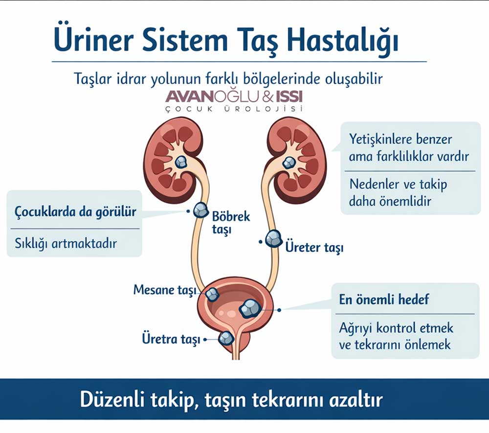 Üriner Sistem Taş Hastalığı tedavisi